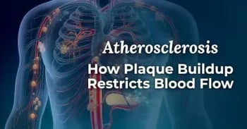How Plaque Buildup Restricts Blood Flow 400