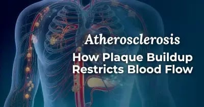 How Plaque Buildup Restricts Blood Flow 400