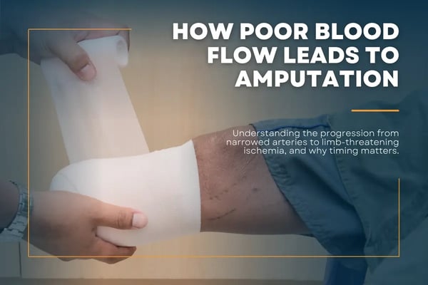 How Poor Blood Flow Leads to Amputation