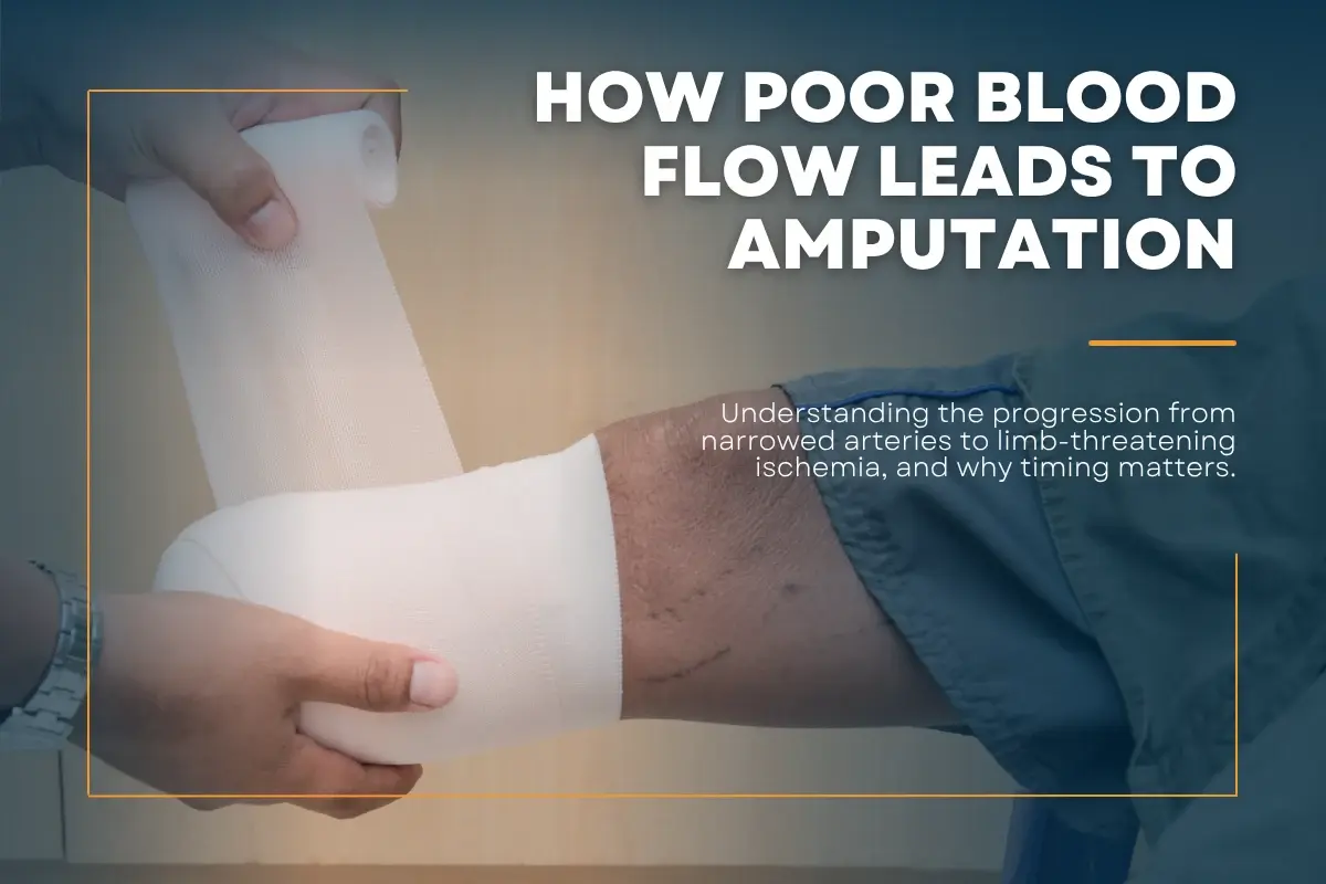 How Poor Blood Flow Leads to Amputation